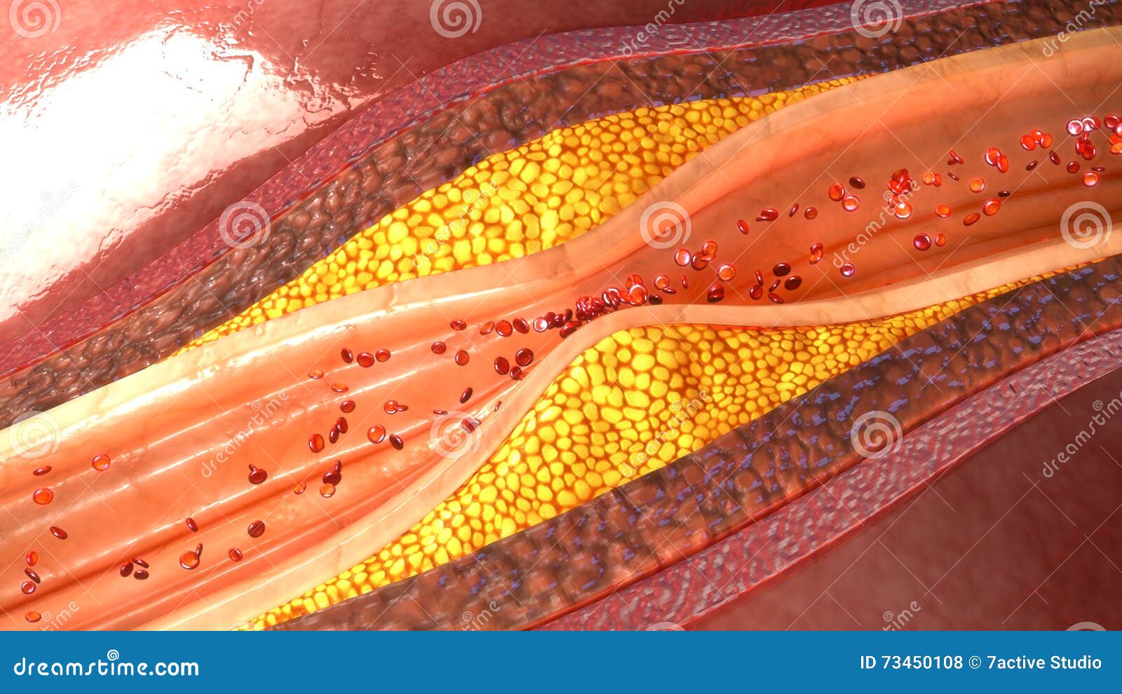 coronary artery plaque