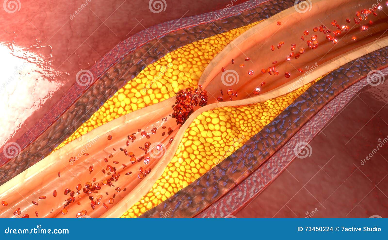 coronary artery plaque