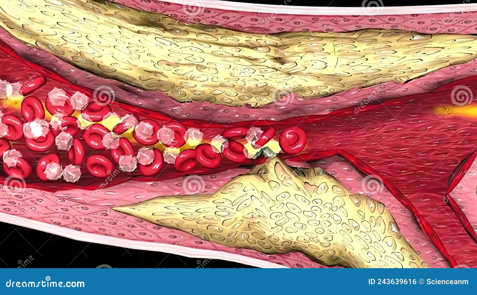 Coronary Atherosclerosis, Light Micrograph Showing Cholesterol