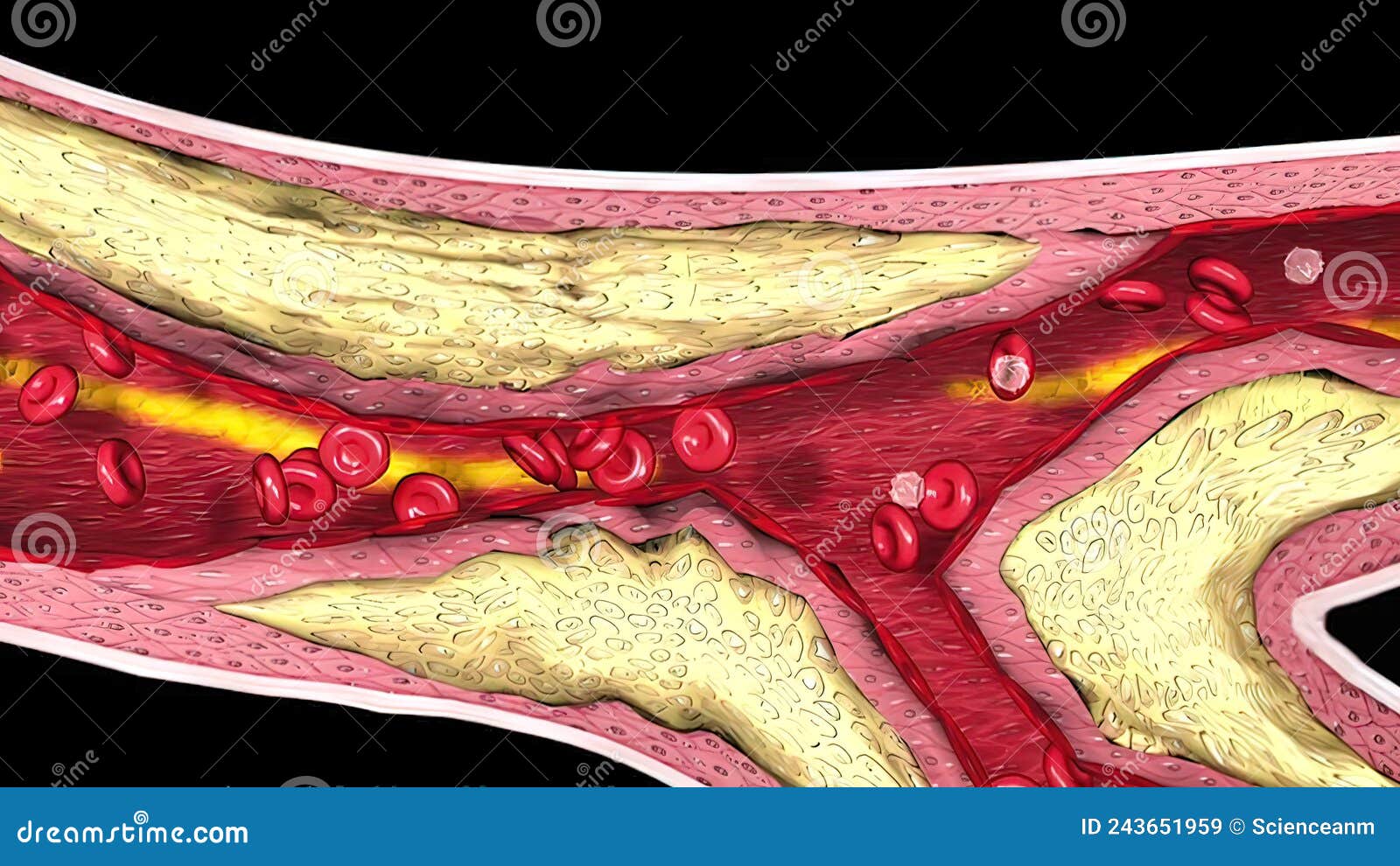 Coronary Atherosclerosis, Light Micrograph Showing Cholesterol
