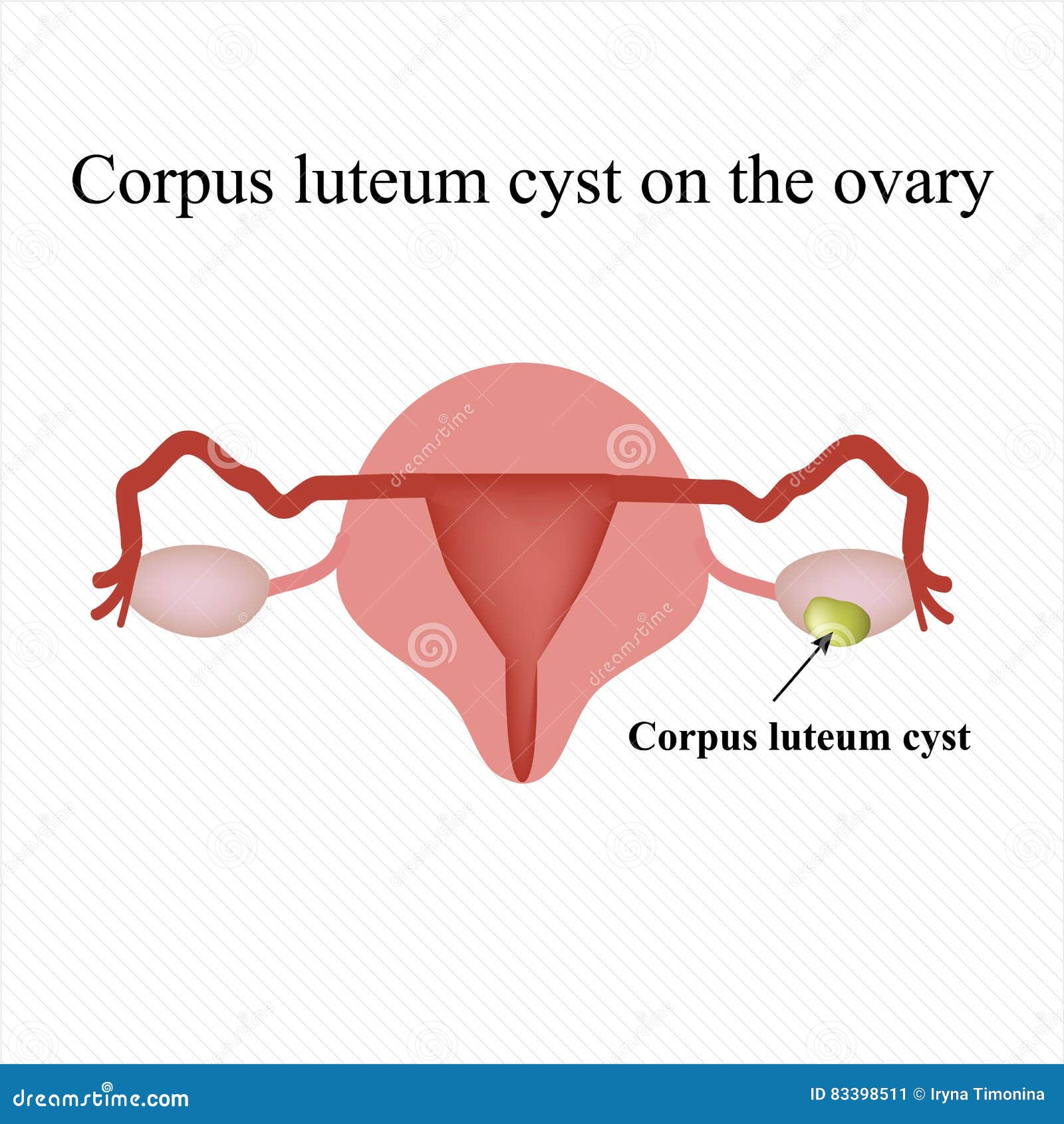 Corpus LuteumZyste Auf Dem Eierstock Funktionell Infographics Auch Im Corel Abgehobenen Betrag