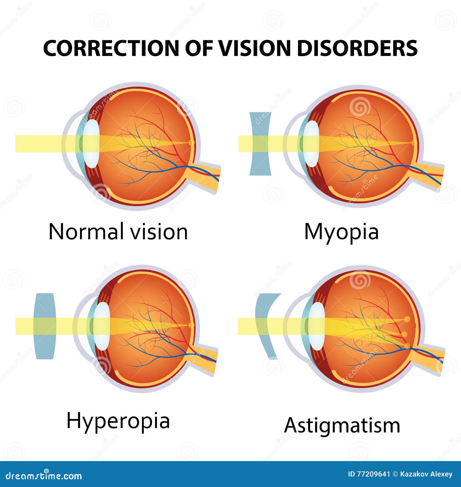 correction of various eye vision disorder.