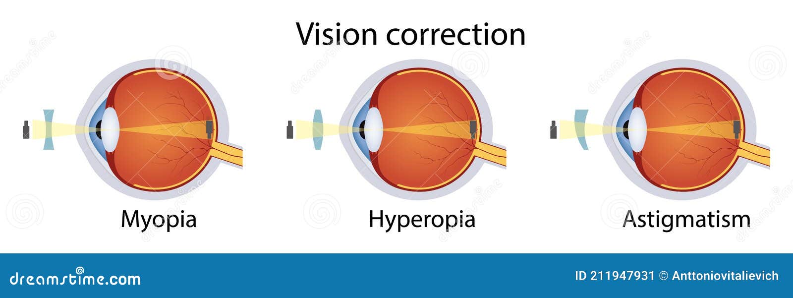 examen hipermetropie miopie faceți operație oculară cu hipermetropie