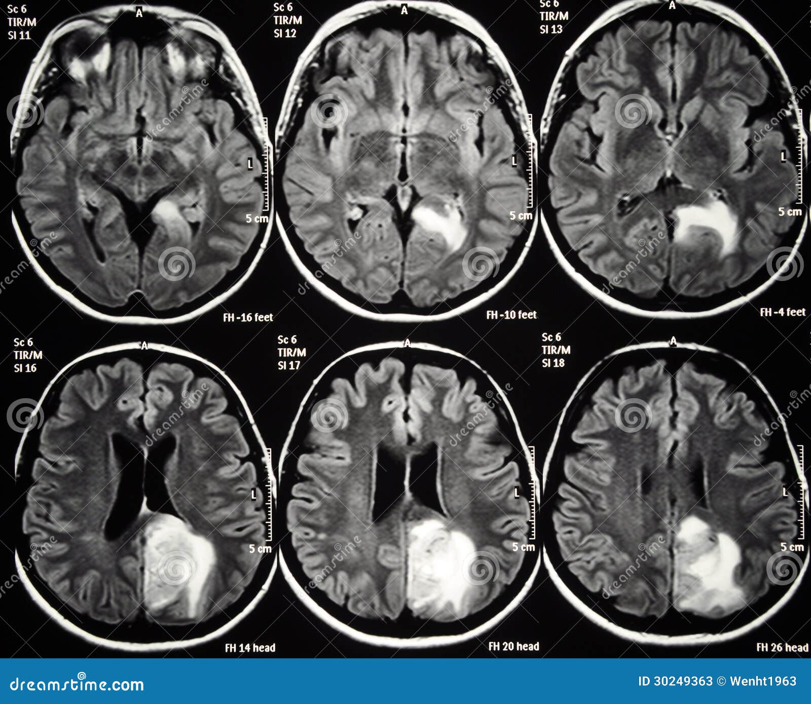Tumor Cerebral Fotos De Archivo Imagen 30249363 how-big-is-a-2-cm-tumor-google-search-tumor-watermelon-cranberry