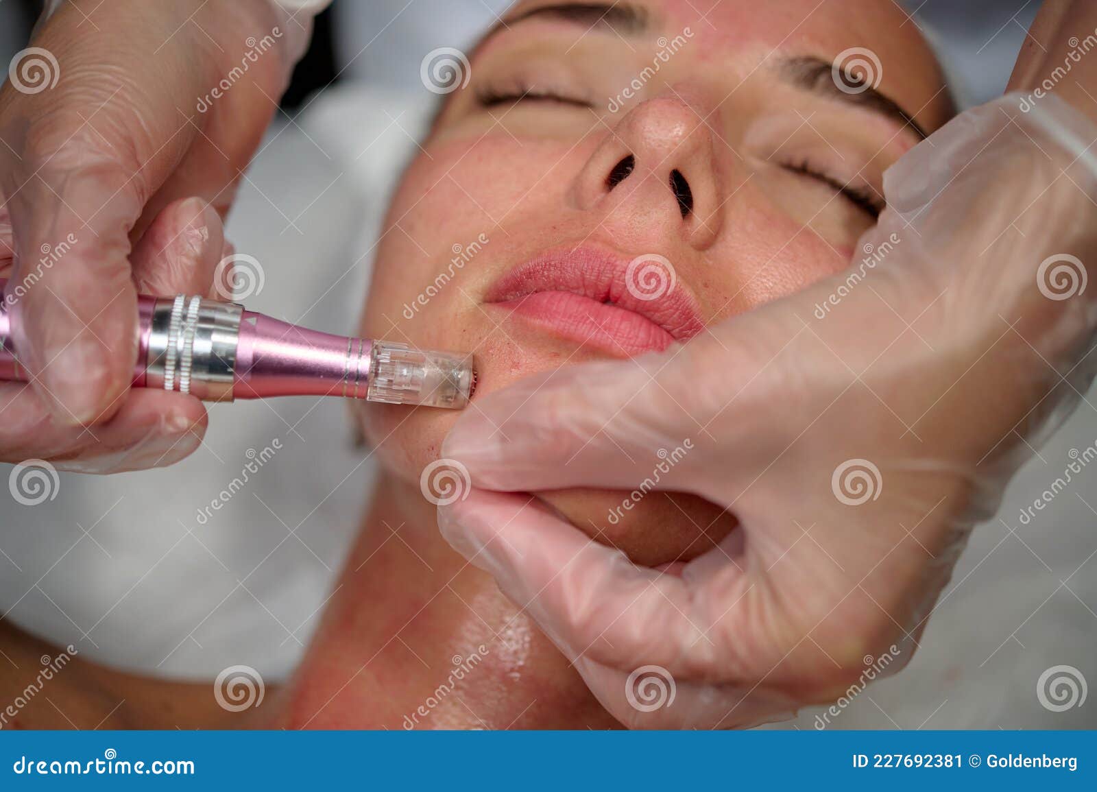 anti-aging care with dermapen, patient face close-up