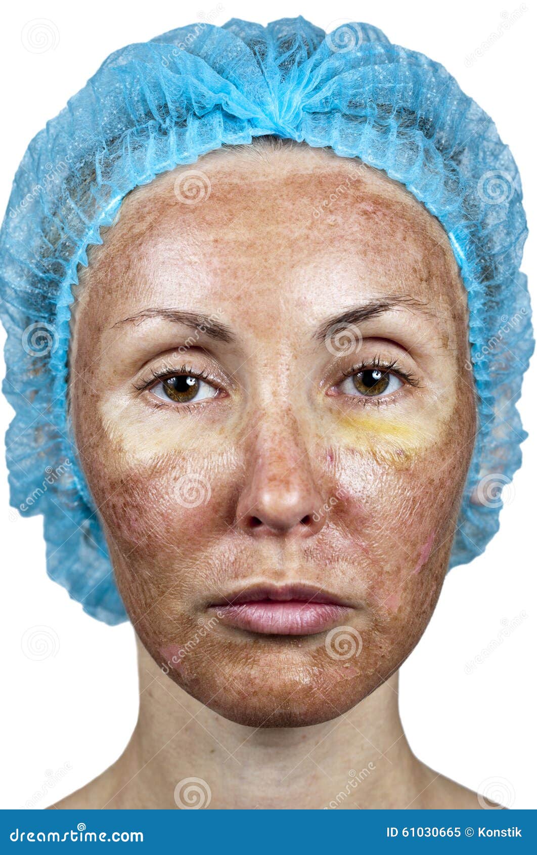 Cosmetology. Skin in the Course of Rejection after a Deep Chemical