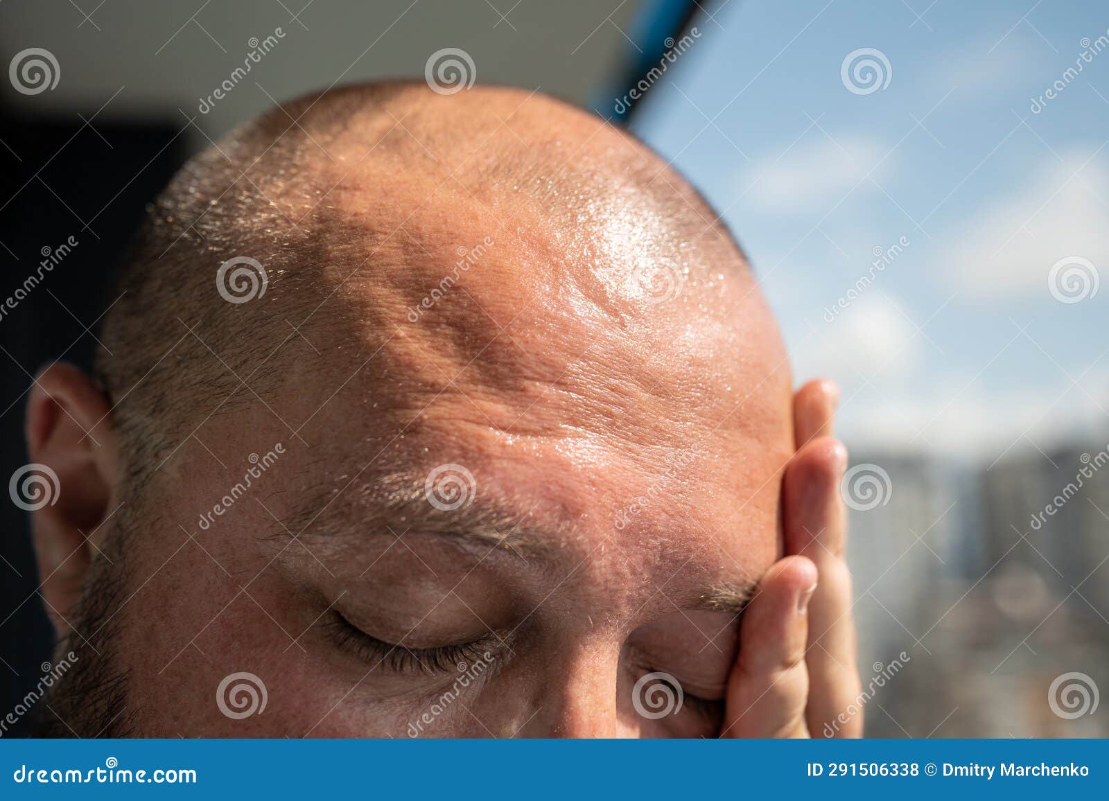 Coup De Soleil Sur Le Front De L'homme Transpiration Sur La Tête ...