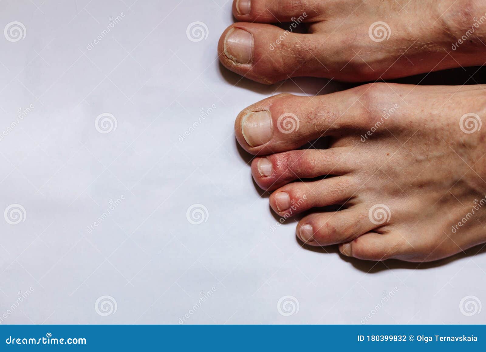 covid toes . another another symptom of coronavirus infection. painful red and purple bumps that tend to occur at the tips of the