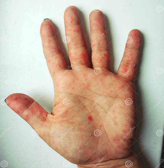 Coxsackie virus stock photo. Image of disease, hand 107163278