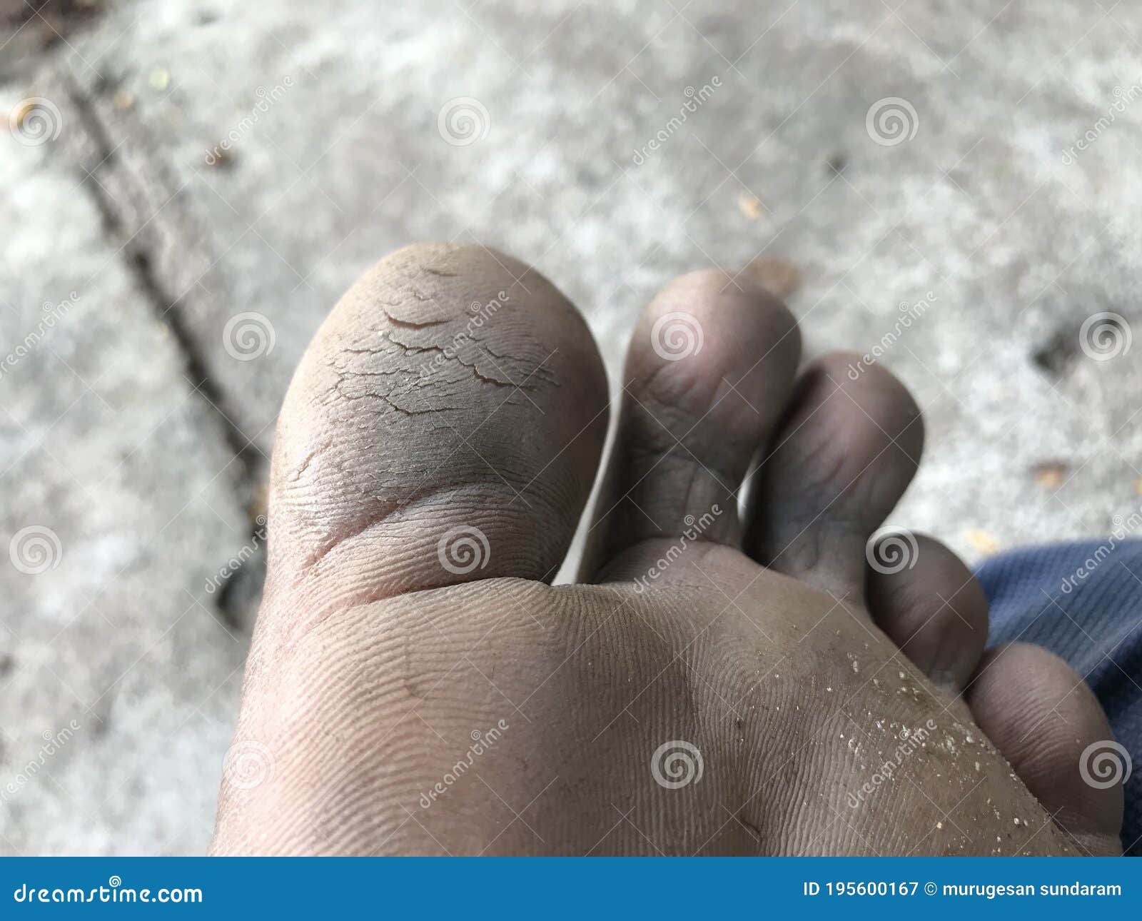 Cracked Heels on Fingers of Left Legs Which Needs Medications Stock