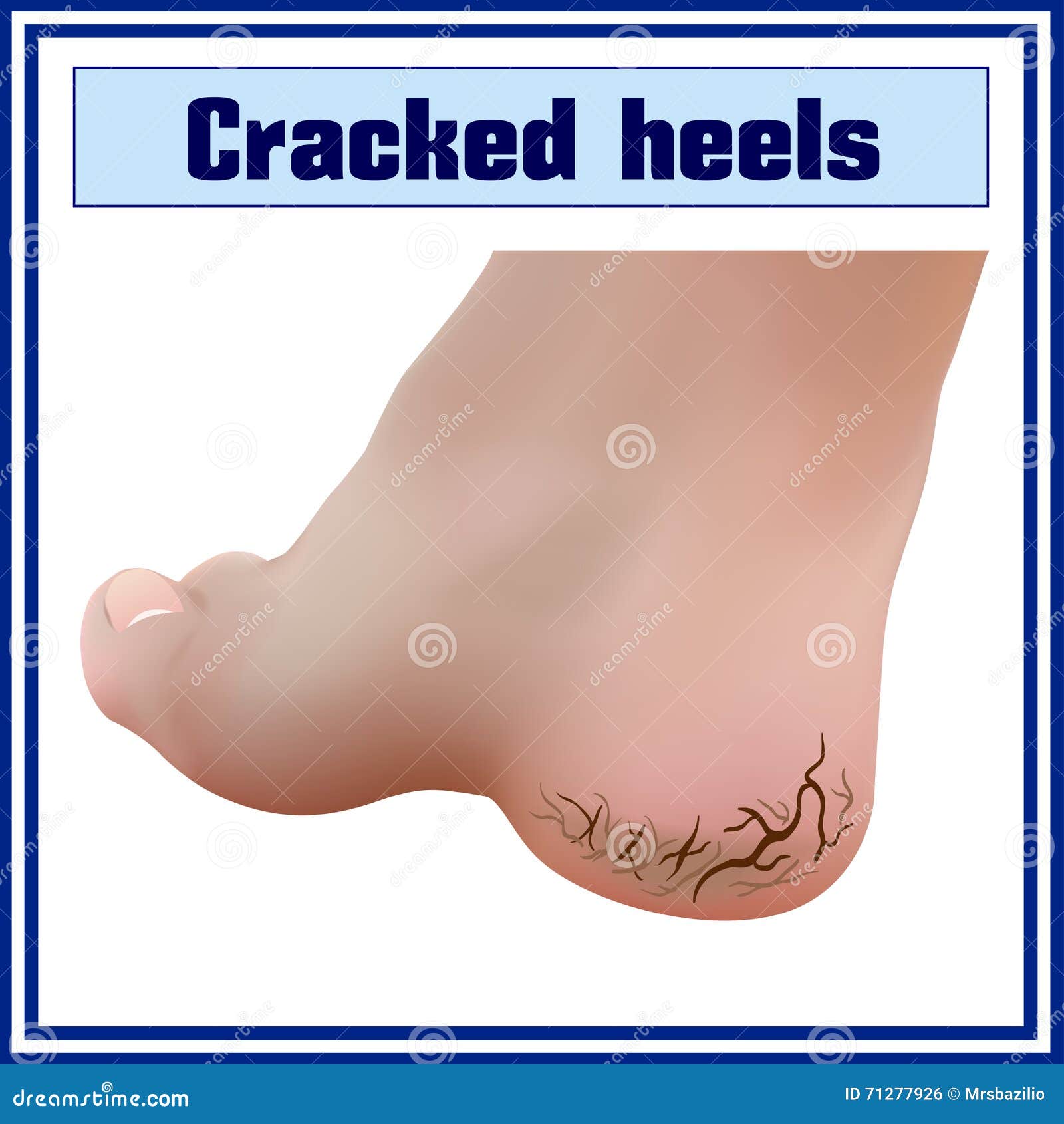 cracked heels. foot diseases. dermatology.