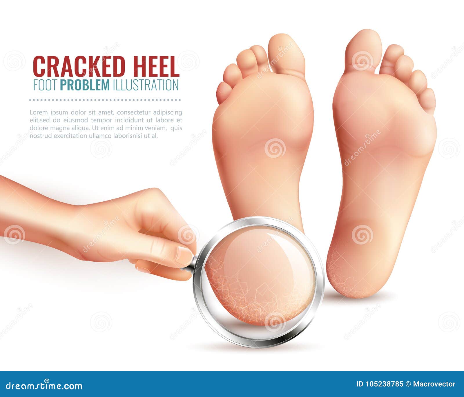 Cracked Heels before and after Treatment and Treatment. Medical Pedicure in  a Beauty Salon Stock Image - Image of pain, medical: 233799723