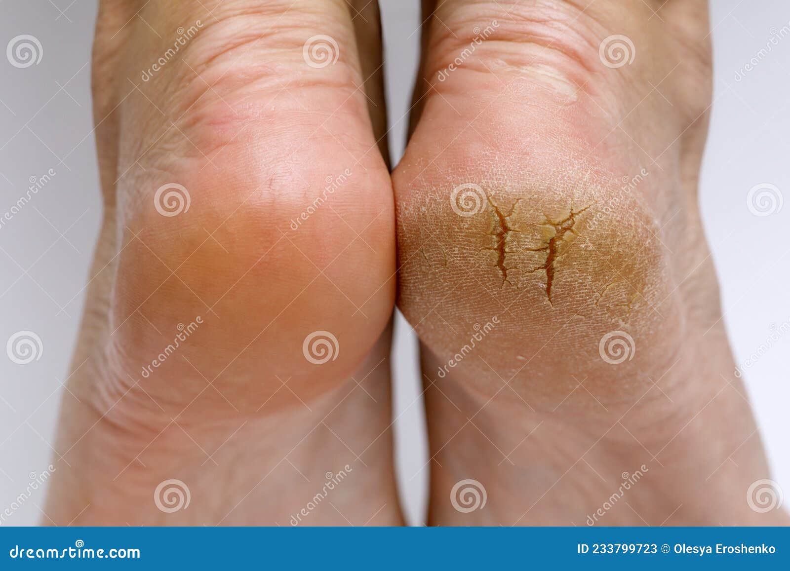 Dry, Cracked Heels? Frequently asked Questions. - Goldman Dermatology