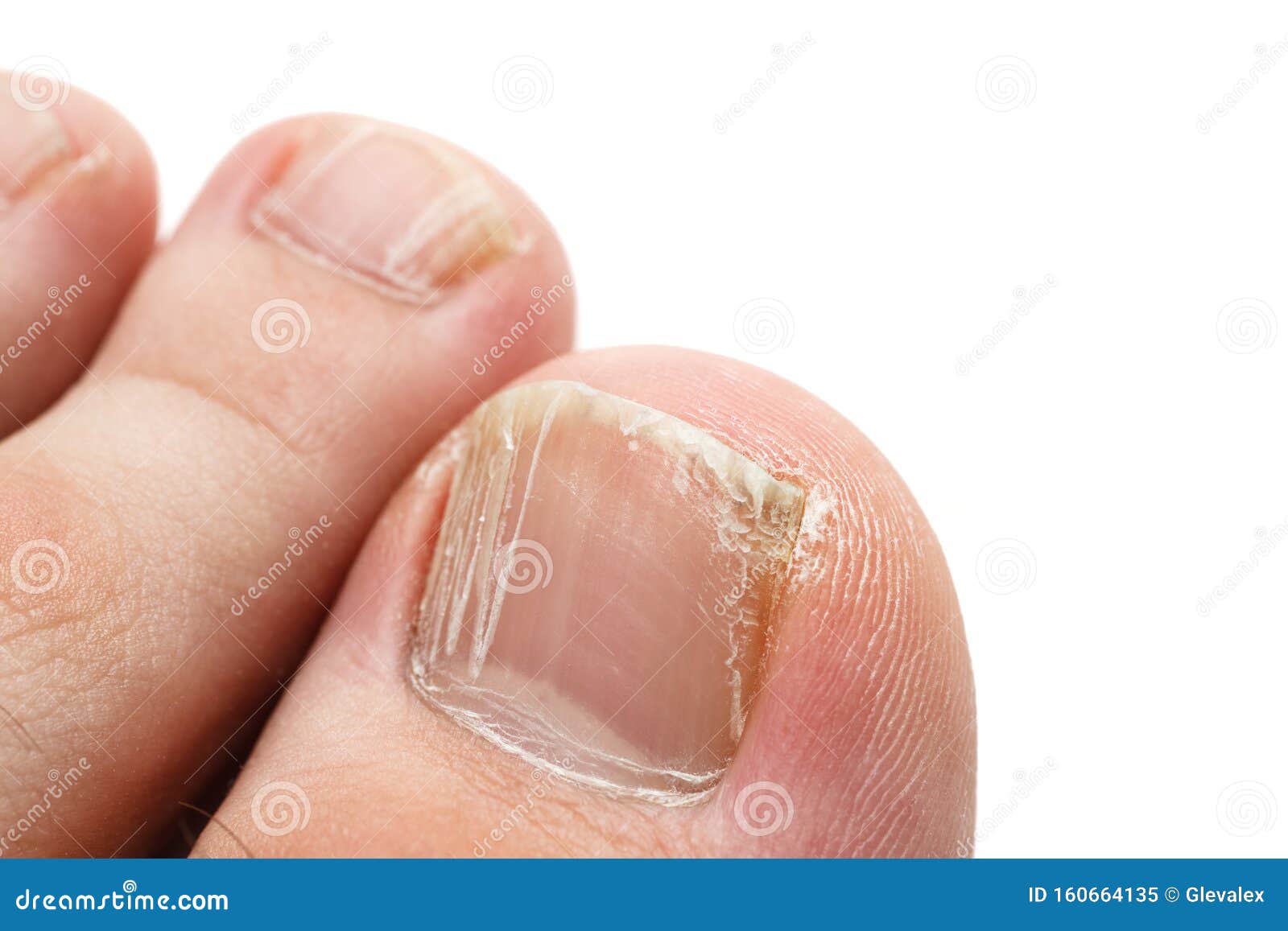Cracked Nails of the Toes Isolated on White, Closeup Shot Stock Image -  Image of isolated, foot: 160664135