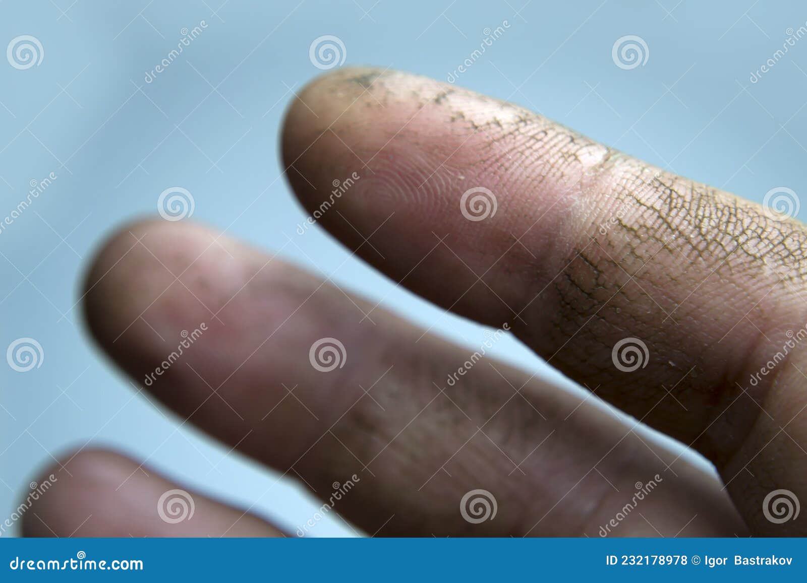 Cracked Skin on the Fingers, Dry Skin. Your Cream Will Help these Hands.  Lack of Vitamins Stock Photo - Image of flaky, dermatology: 232178978