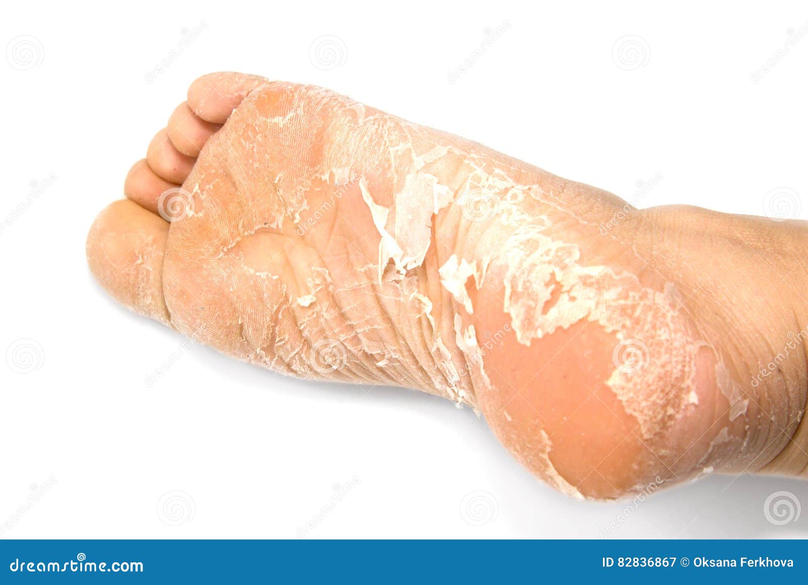 cracked skin on heels of feet