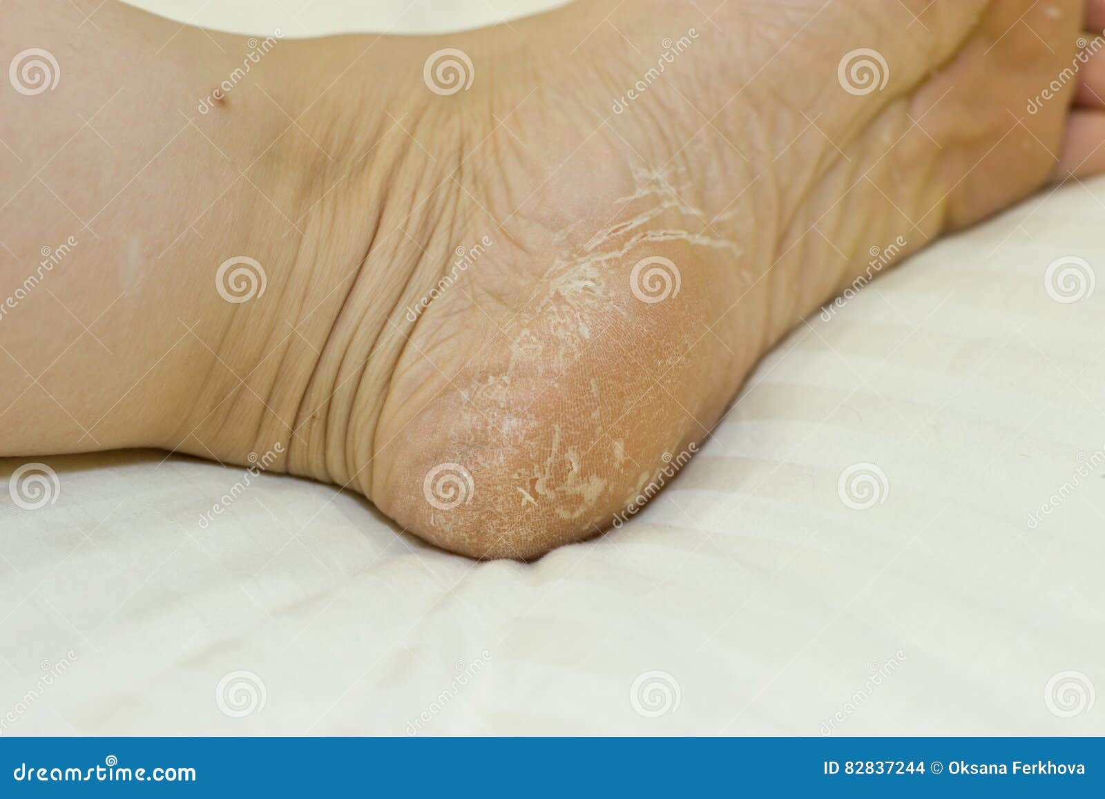 MEZIRE Standard Silicone Gel Heel Socks 1 Pair for Dry Hard Foot Cracked  Heels Repair,Foot Treatment , Heel Protector, Dead Skin Remover, Heel Pain  Relief Open Toe Silicon Foot Care For Men