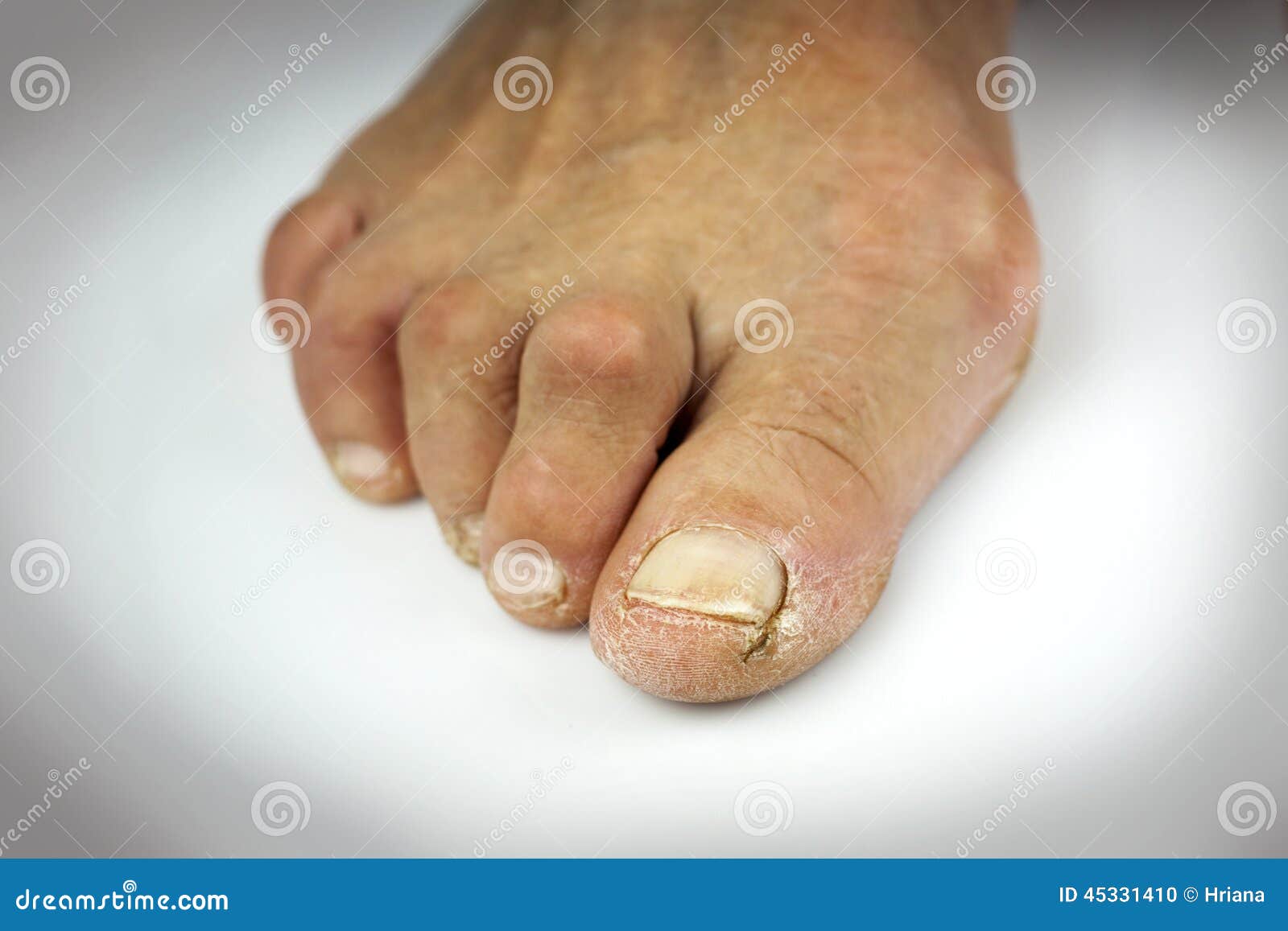 Cracked Toe on White Background Stock Photo Image of body, fungi