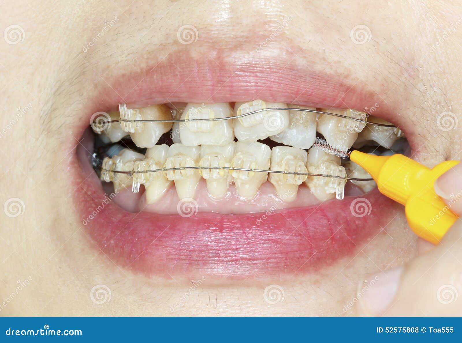 Crooked Teeth with Braces, Interdental Brushing Stock Photo Image of