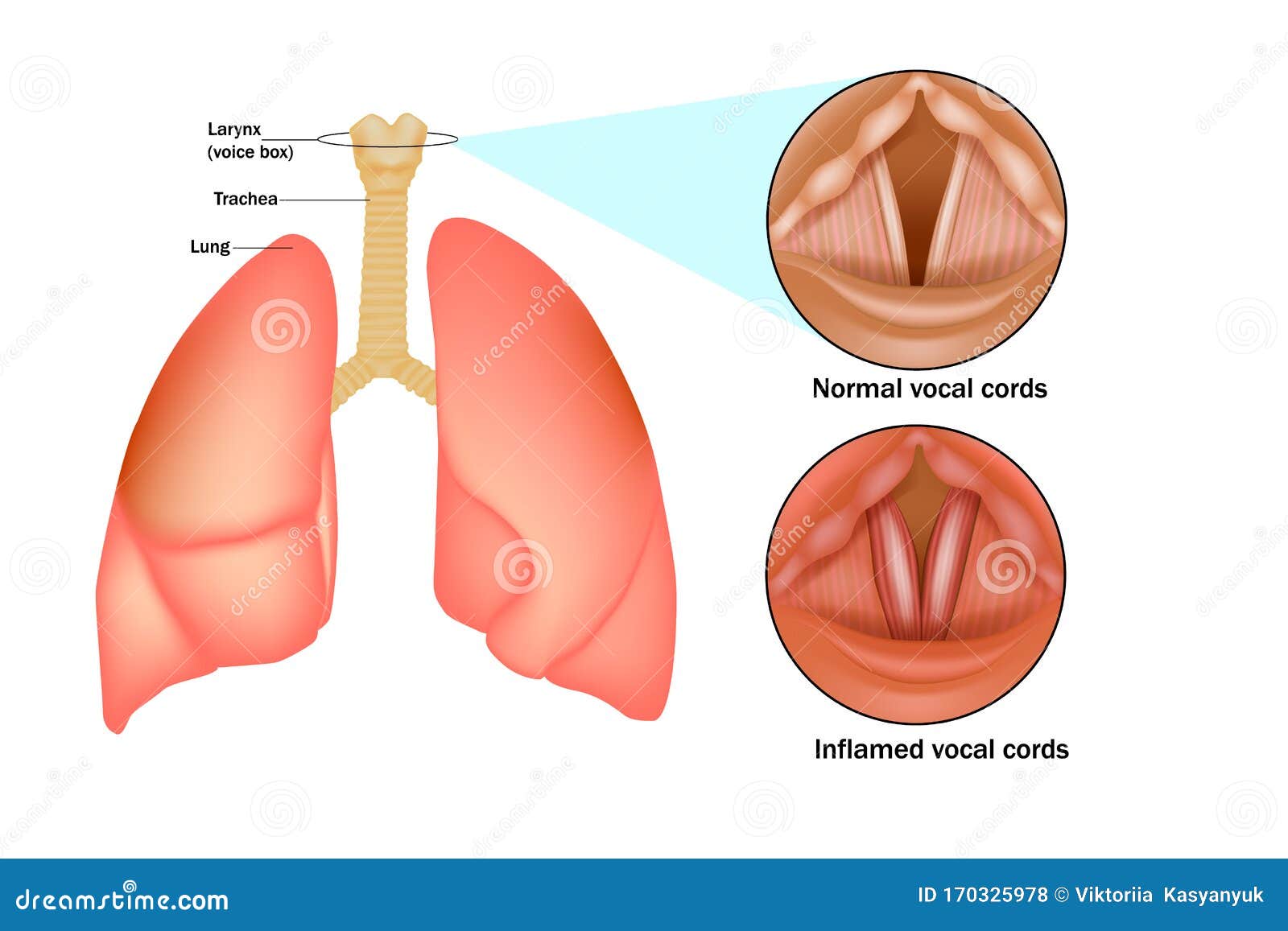 croup laryngo-tracheo-bronchitis.
