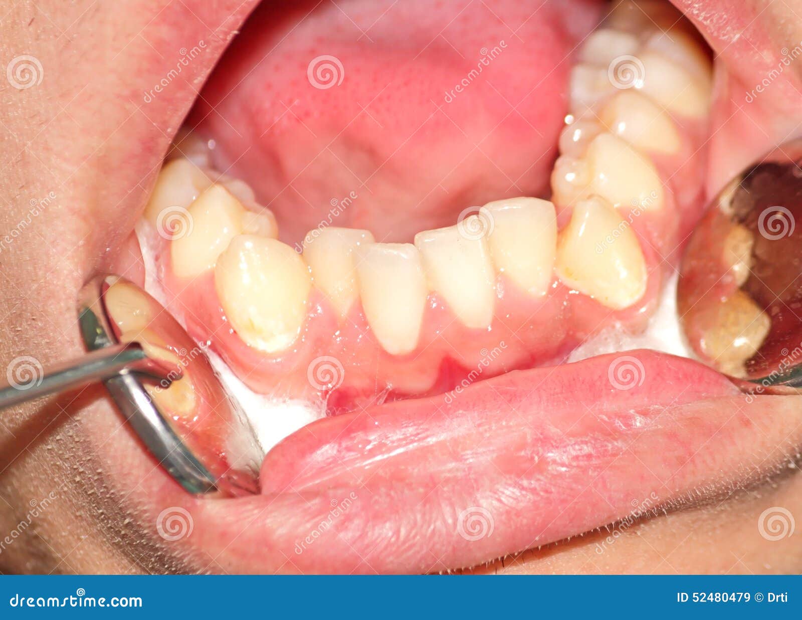 Crowding of the Teeth of the Lower Jaw Stock Image Image of body