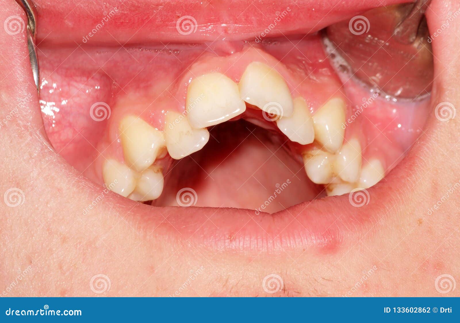 Crowding of the Teeth of the Upper Jaw Stock Photo Image of
