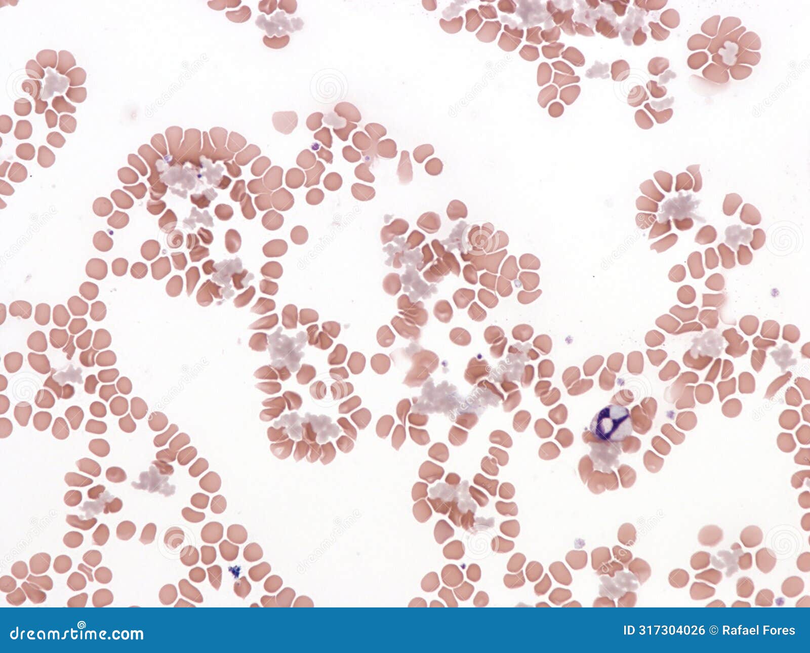 cryoglobulinemia. peripheral blood smear.