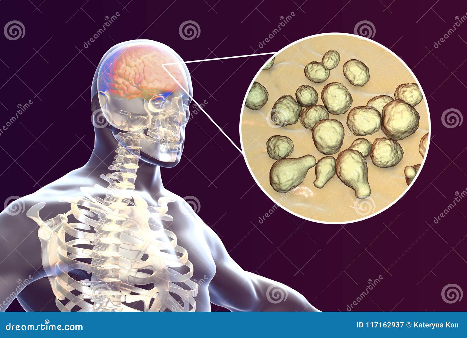 cryptococcal meningitis, medical concept