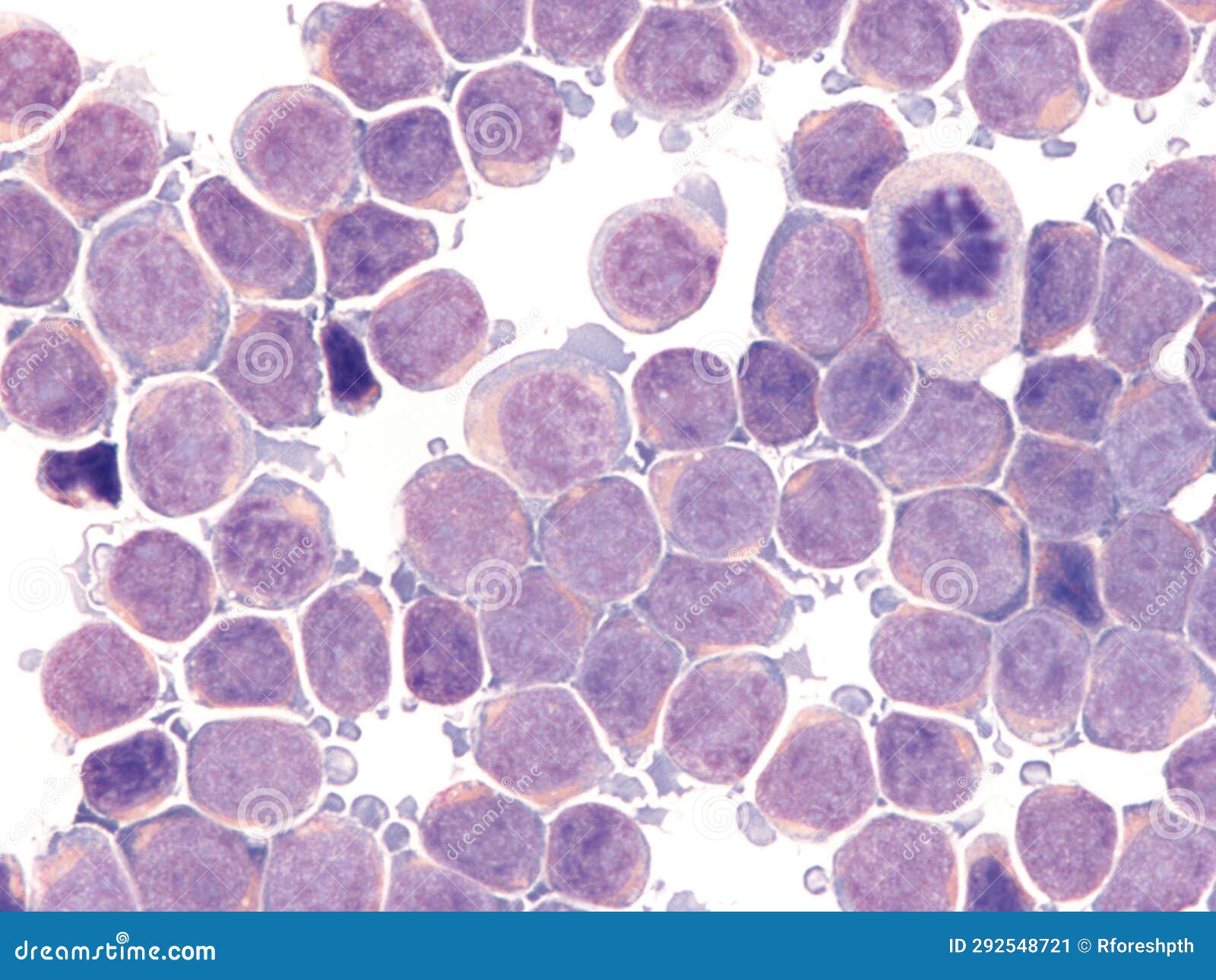 csf involvement in acute lymphoblastic leukemia.