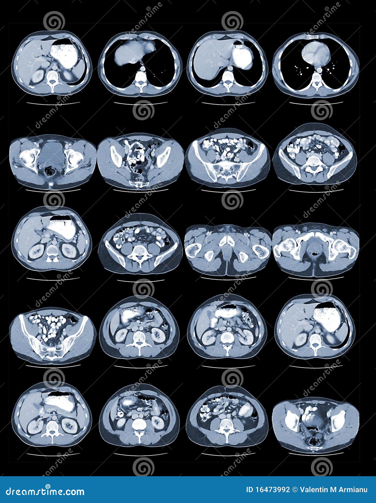 ct abdomen