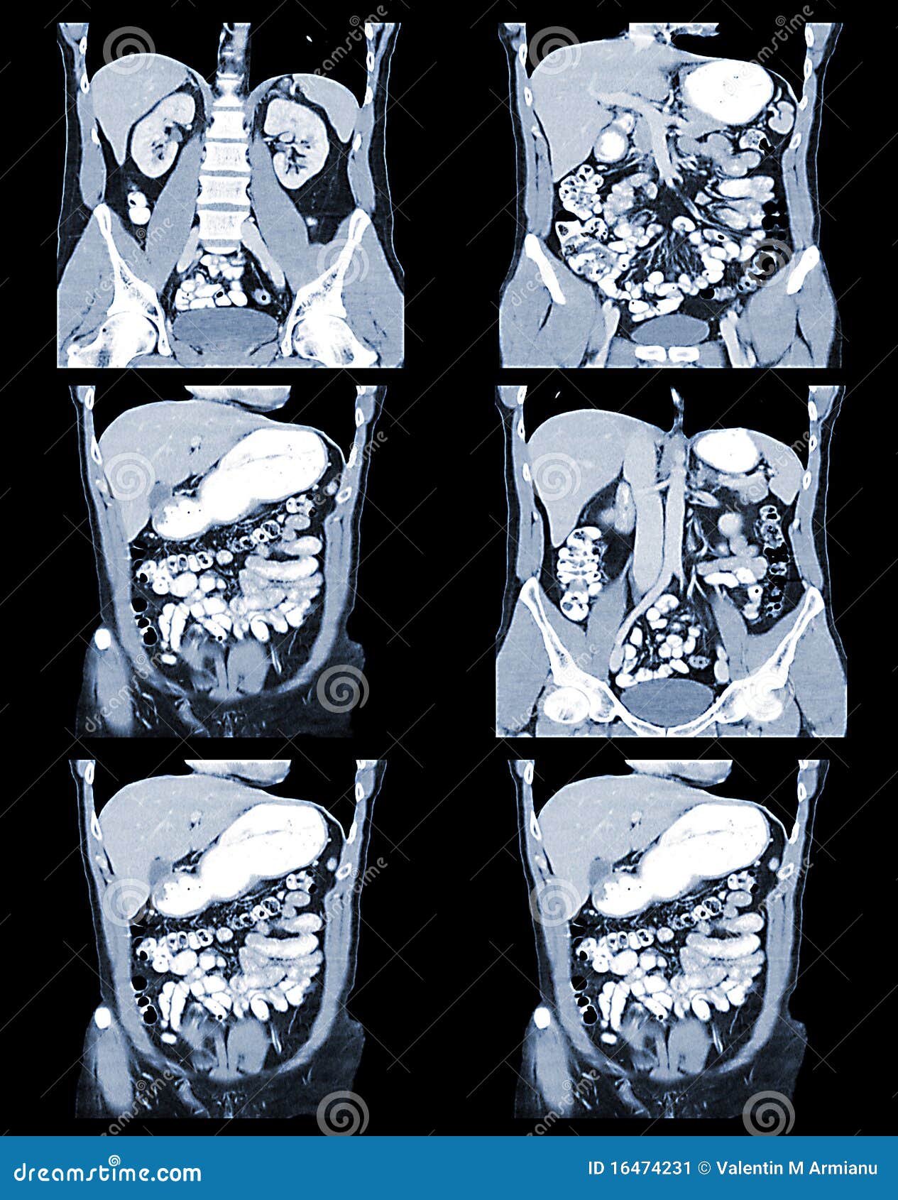 ct abdomen