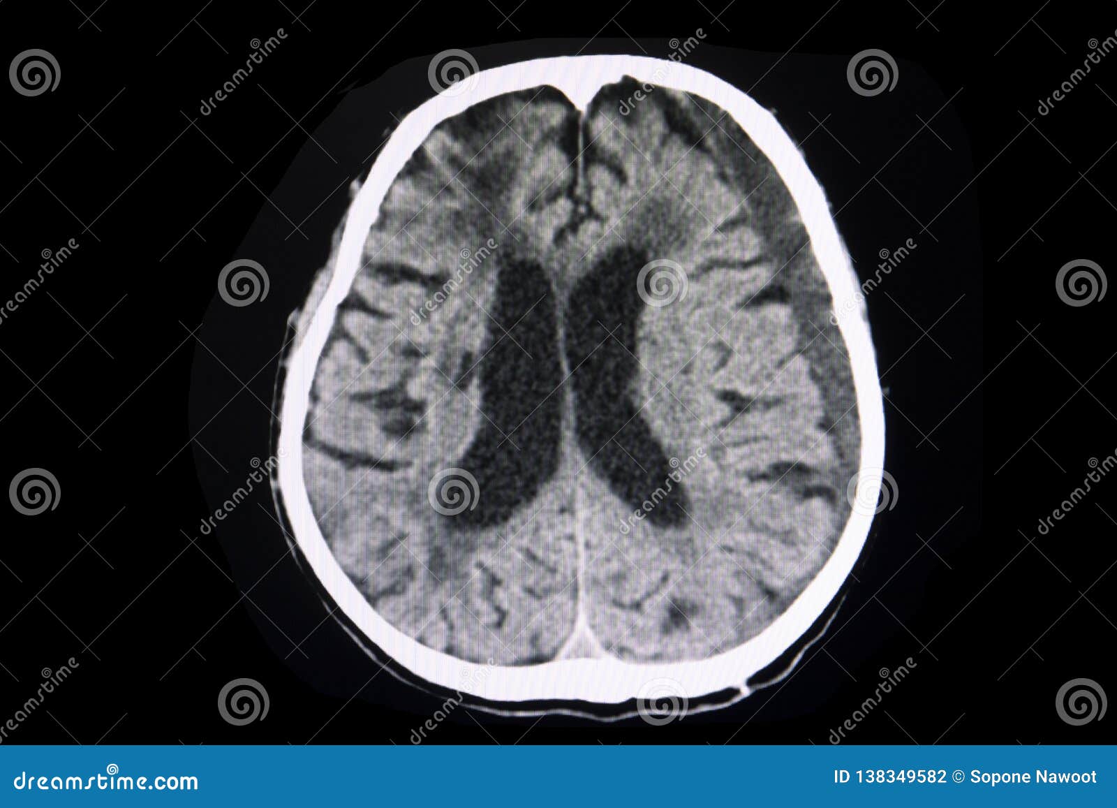 ct brain subacute subdural hematoma