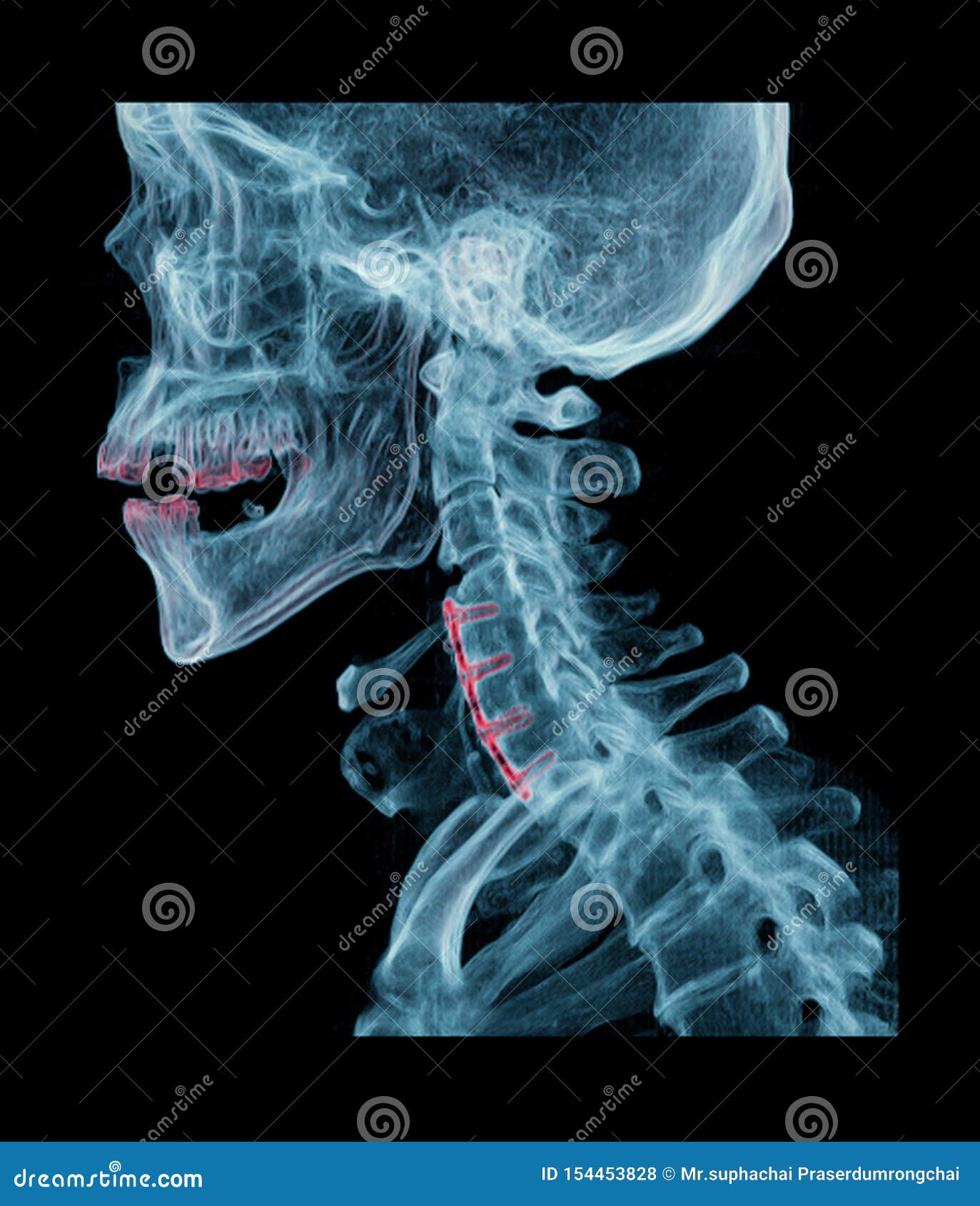 CT C-Spine o Espina cervical 3D Imagen de representación , Vista axial, lateral y coronal con placa y tornillos. Comparación de la imagen de representación 3D de la columna C o de la espina cervical, vista axial, lateral y coronal con placa y tornillos