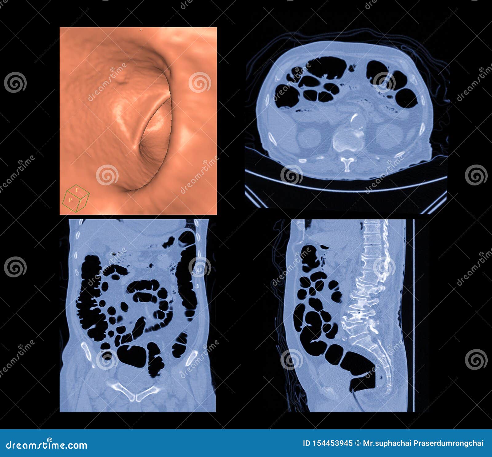 ct colonography compare 3d and 2d axial,sagittal ,coronal plane