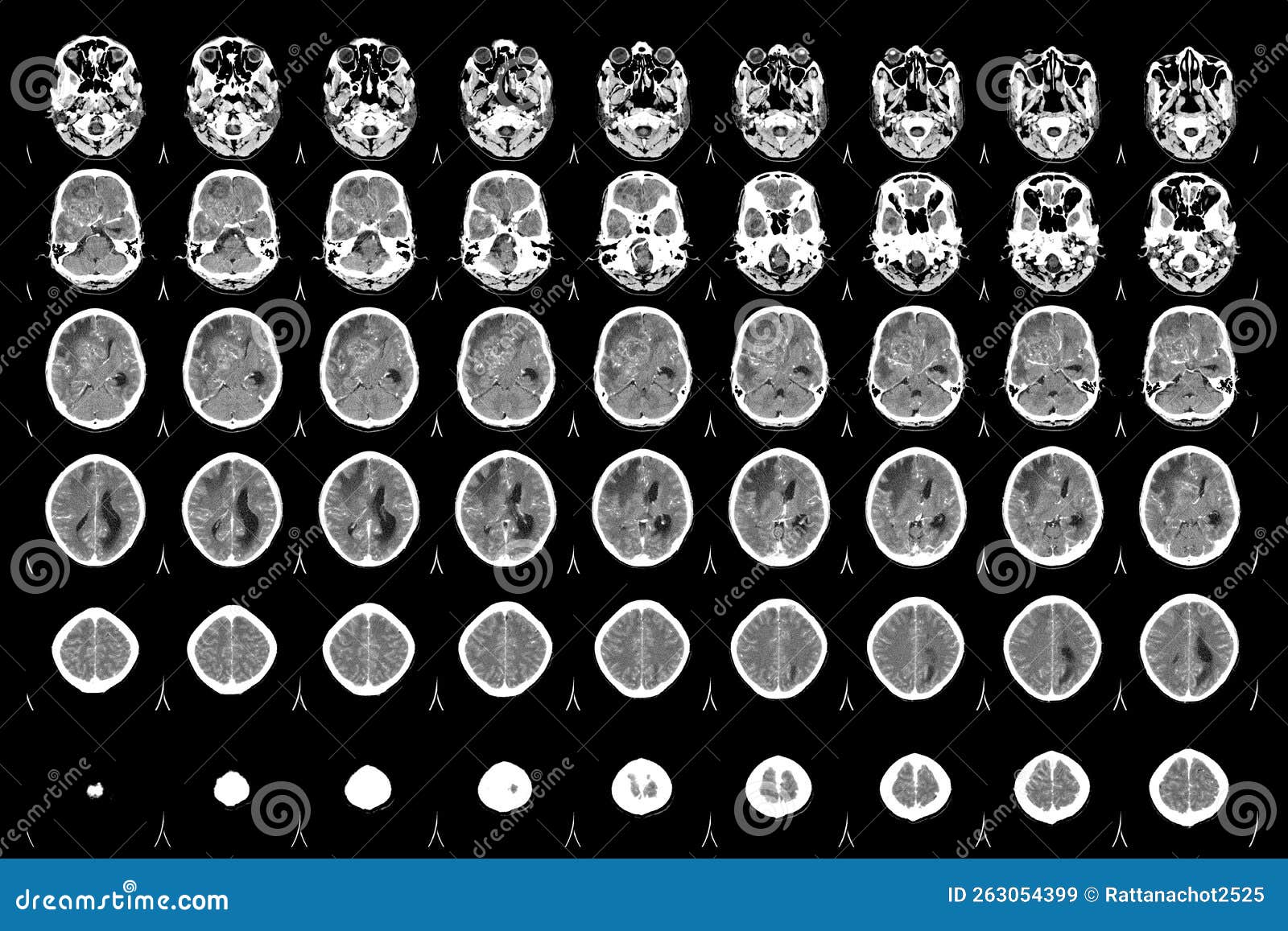 ct scan brain axial views .to evaluate brain tumor. glioblastoma, brain metastasis isodensity mass with an ill-defined margin and