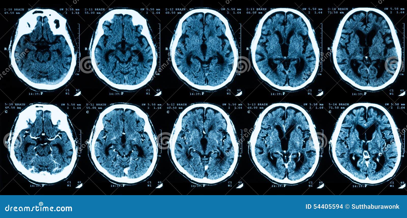 Brain 164. Hemoragia CT scan Angiography Brain contrast. Photo Hydrocephalus Comparison of the Brain.
