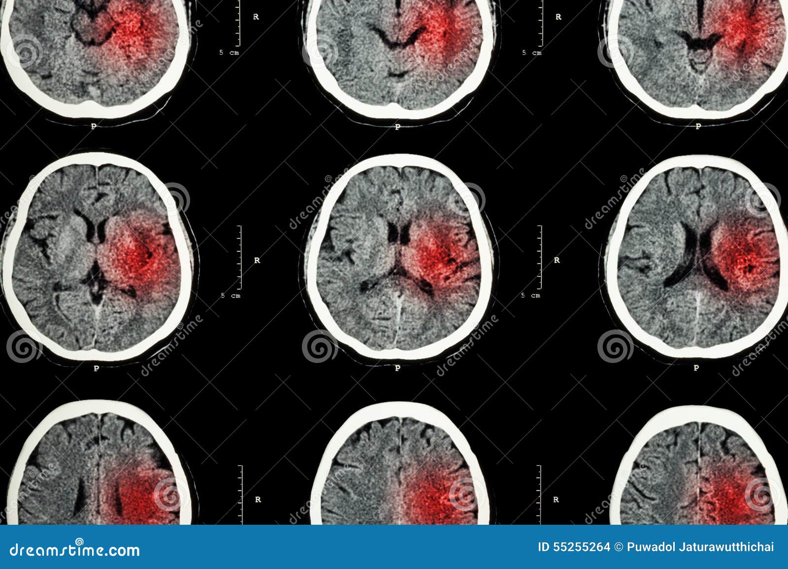 ct scan of brain with red area ( imaging for hemorrhagic stroke or ischemic stroke ( infarction ) concept )