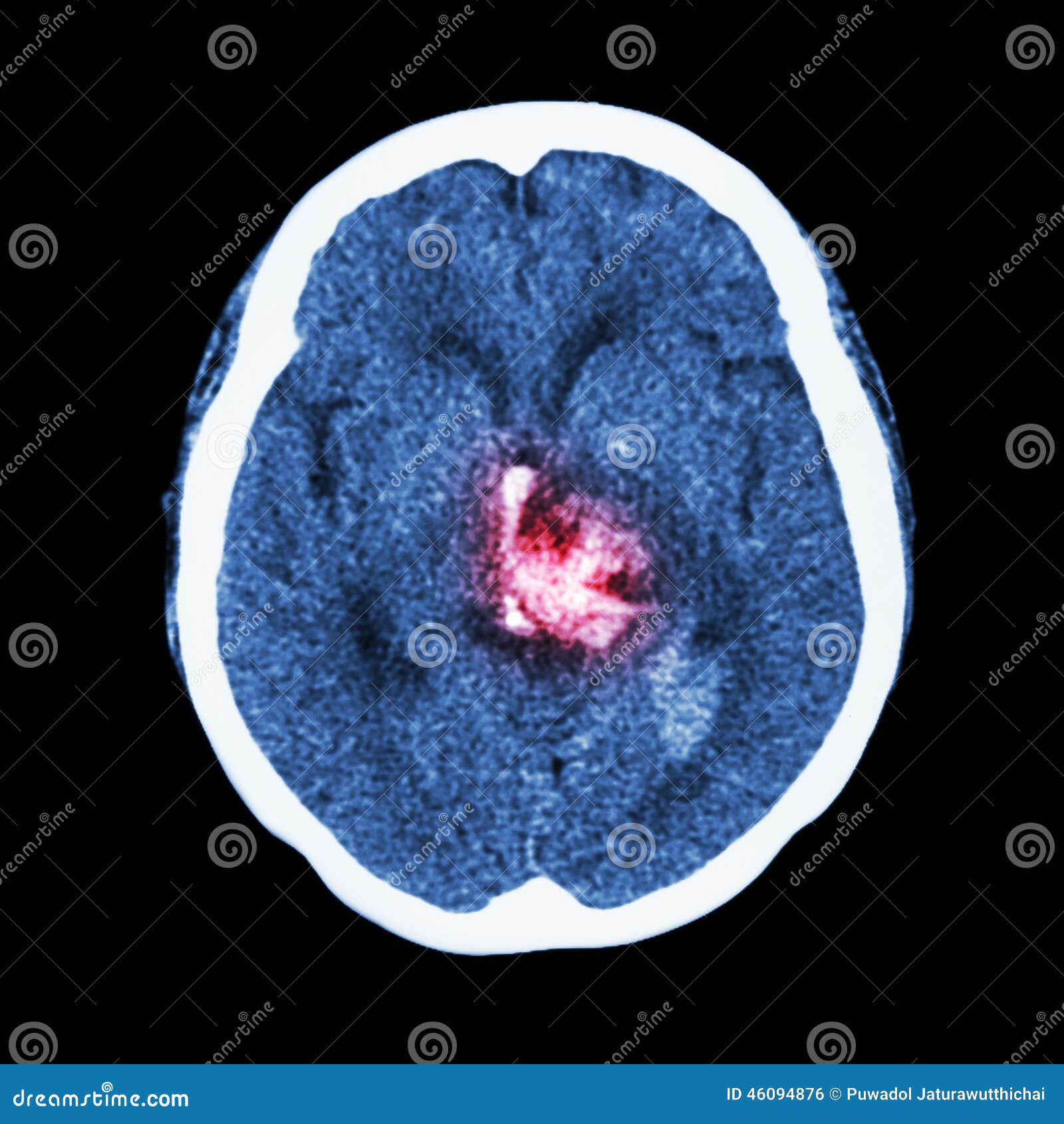 ct scan of brain : show hemorrhagic stroke