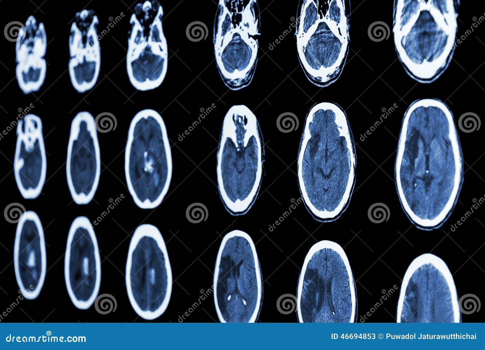 ct scan of brain show ischemic stroke and hemorrhagic stroke