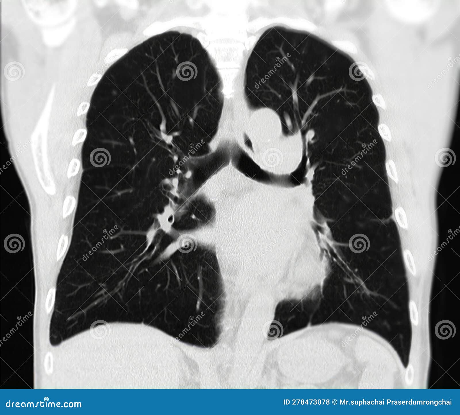 Ct Scan Of Chest Or Lung For Screening Lung Nodules And Lung Cancer Ct Scan Of Chest Or Lung For Screening Lung Nodules And Lung Cancer