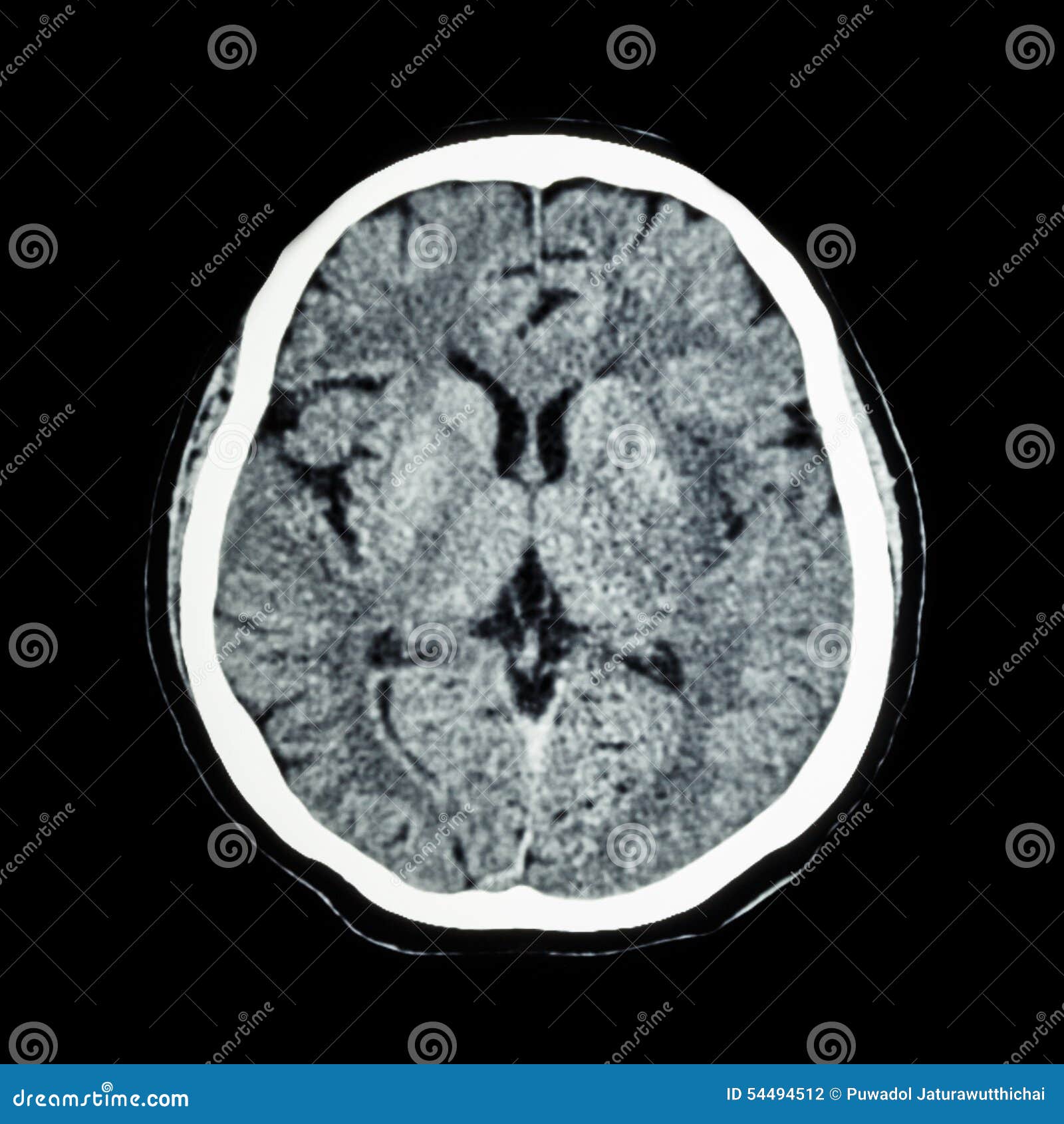 Ct Scan Des Gehirns S Gehirn Zeigen Sie Des Normalen Menschen Computertomographie Stockfoto Bild Von Scan Menschen