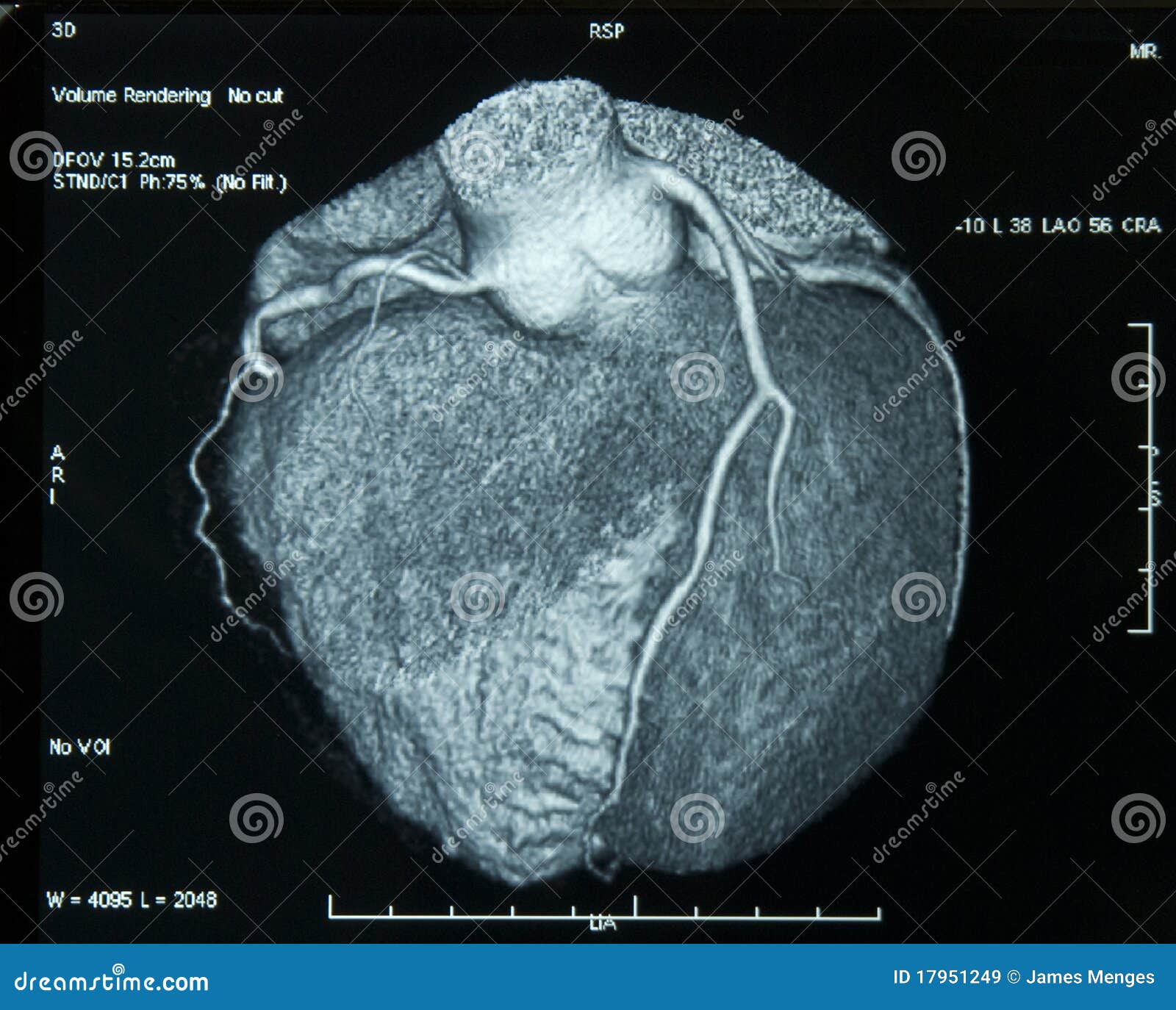 ct-scan heart