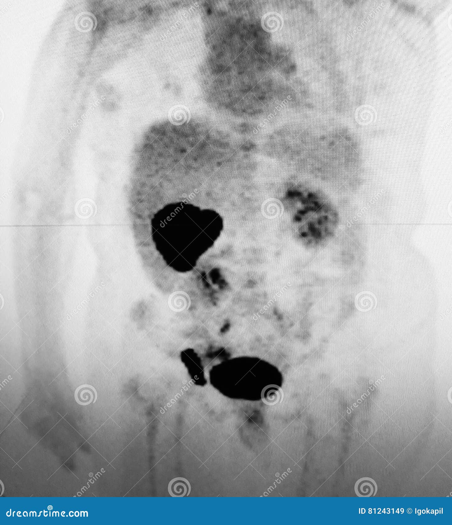 Black Spots On Ct Scan Of Abdomen Captions Hunter