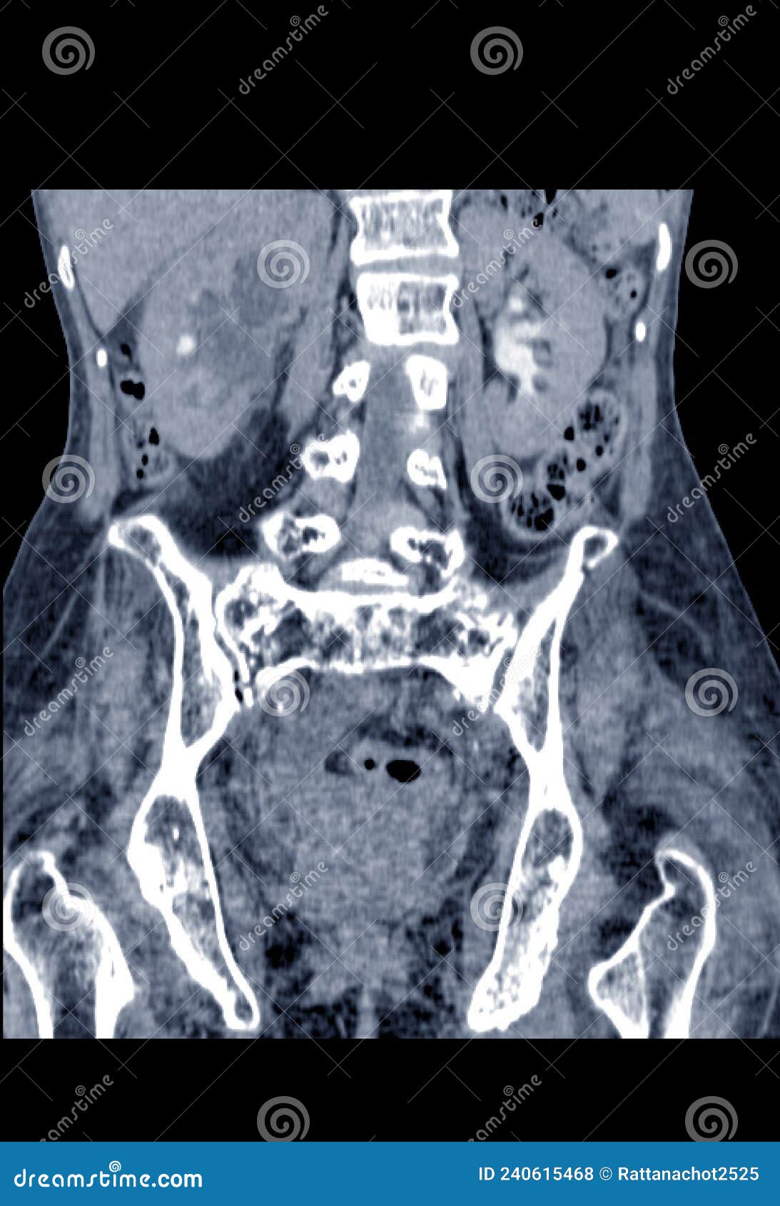 Ct Scan Lower Abdomen Severe Hydronephrosis Rt Kidney With Distal