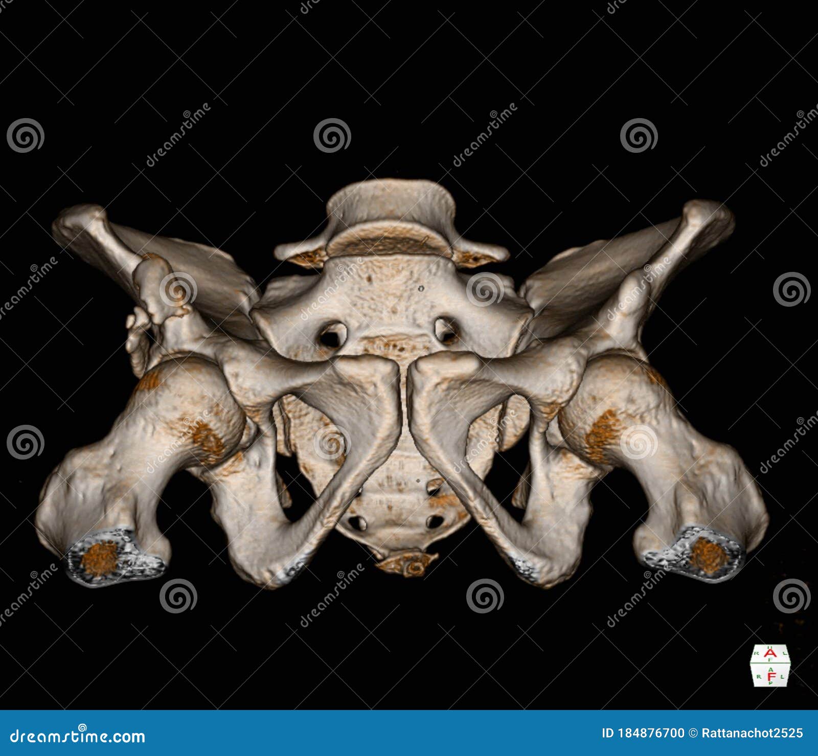 Ct Scan Pelvis Bone 3d Rendering Image Isolated On Black Background Showing There Is A 8mm Thick And 5cm Long Tubular Ossification Stock Illustration Illustration Of Exam Anatomy 184876700