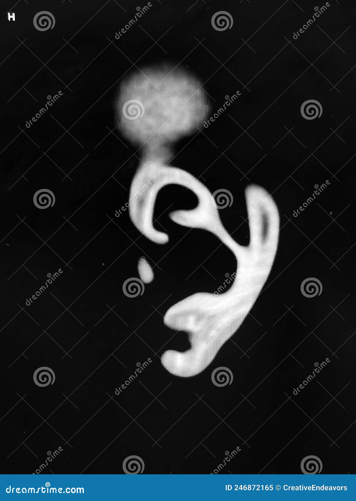 CT Scan of Pinna, Ear Cartilage Black,white Stock Image Image of organ, perception 246872165