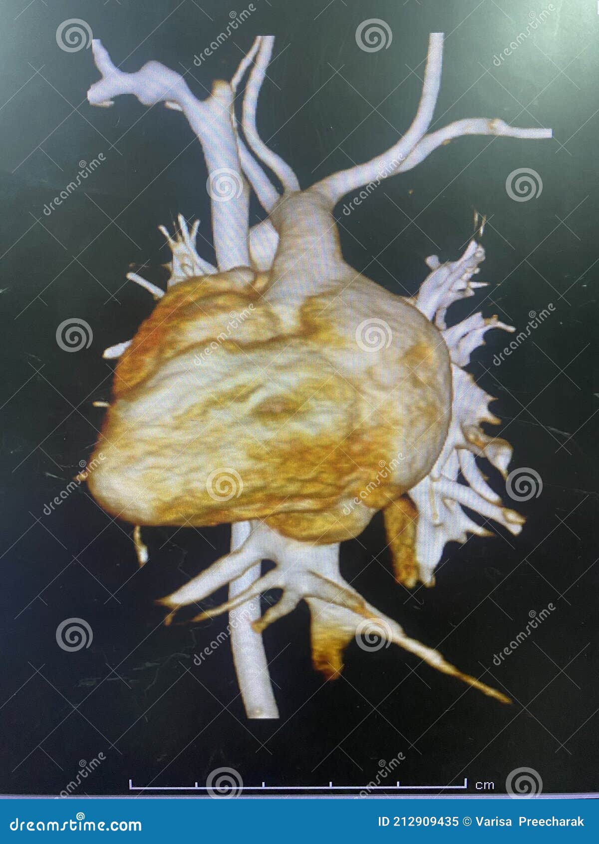 ct scan angiogram show dextrocardia the congenital heart disease