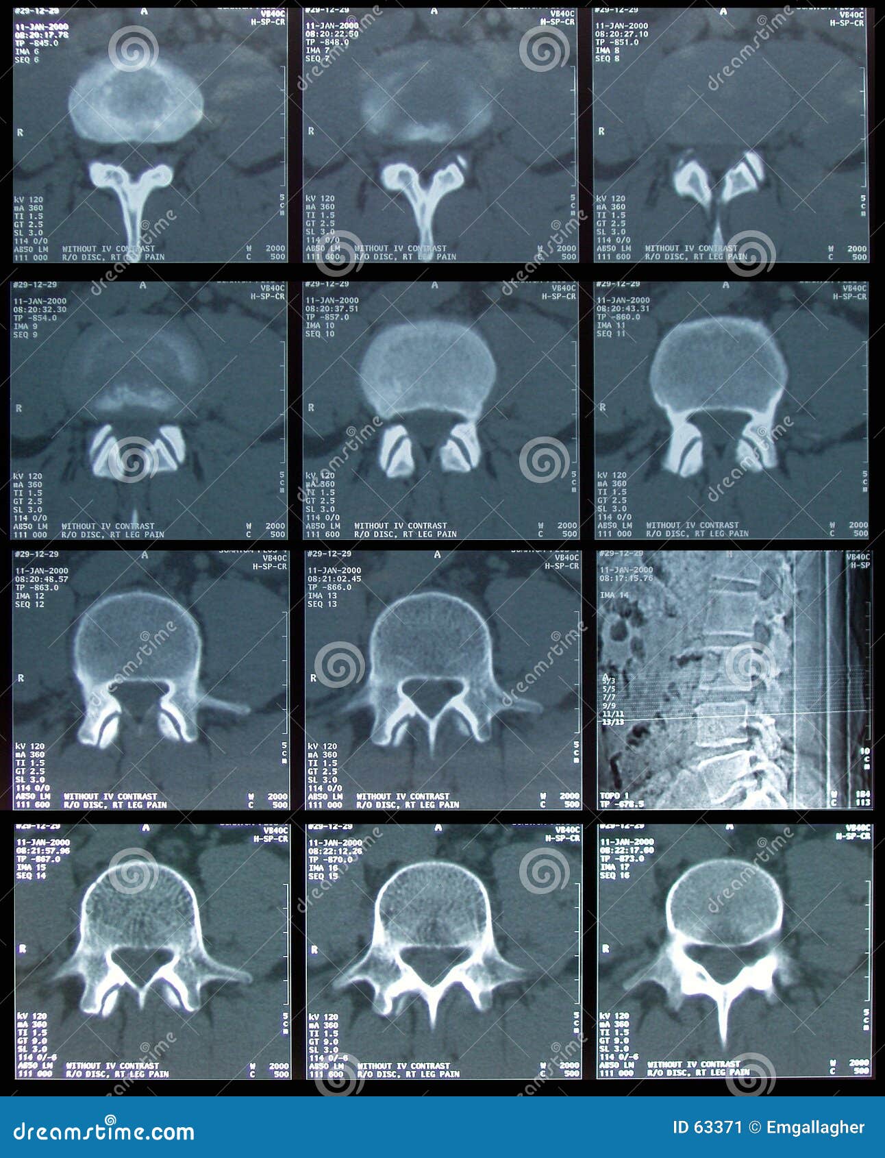 ct scan of spine