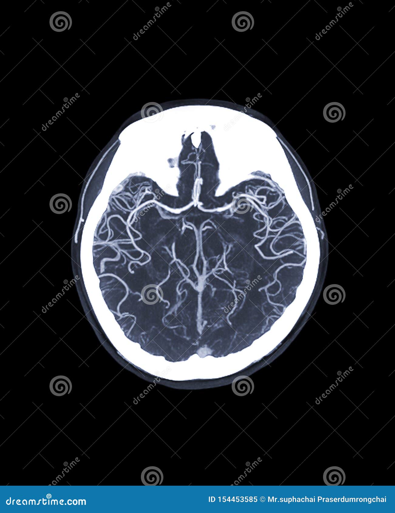 Cta Brain Anatomy