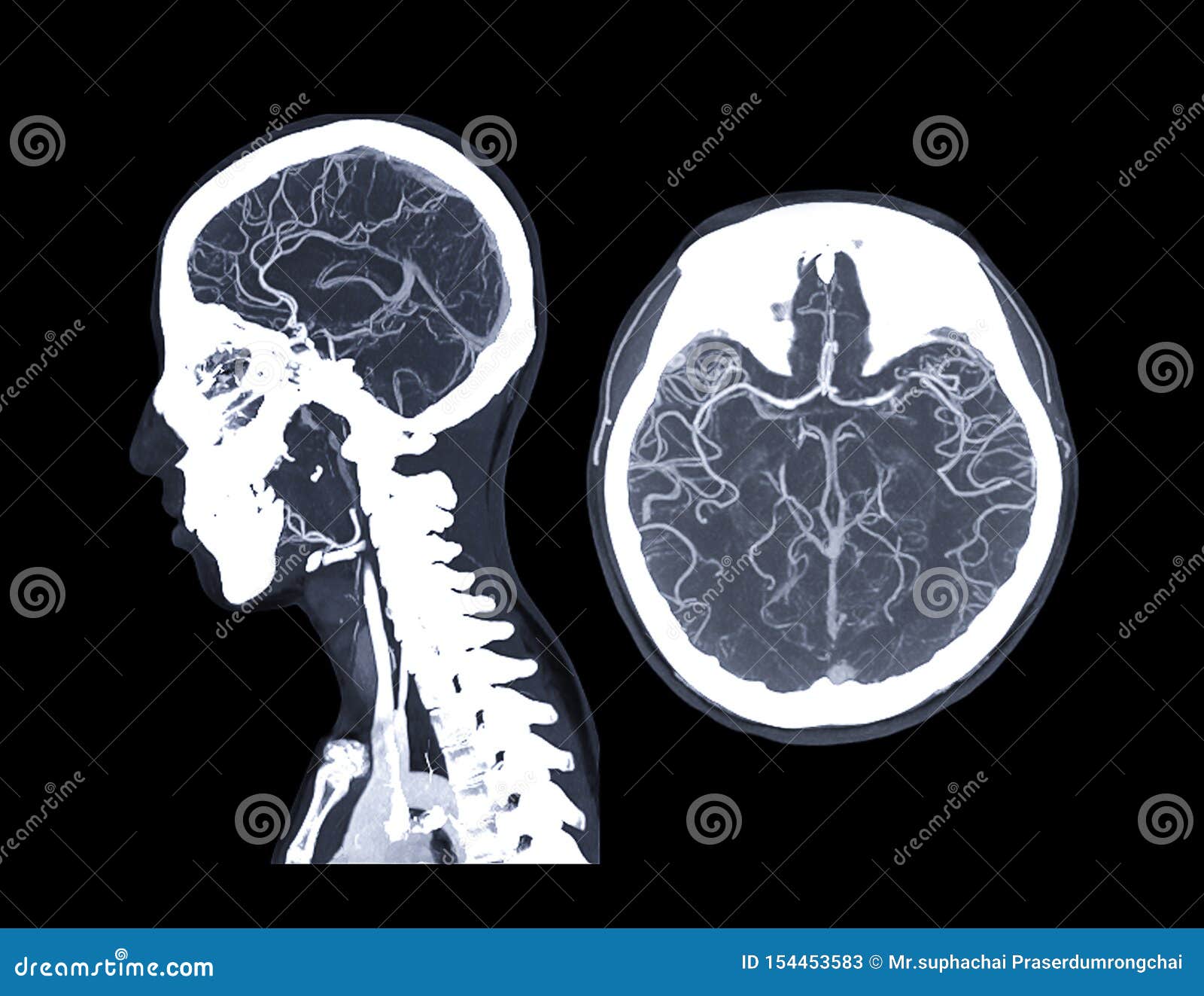 cta brain or ct angiography of the brain .